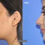 drdhir_nose_34_5_1