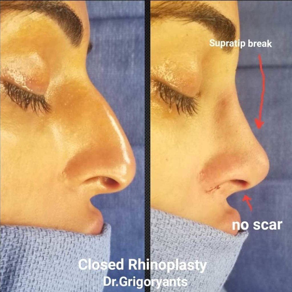 The Best Rhinoplasty Surgeons in L.A.