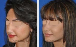 rhinoplasty_nose_bev_6cIxq