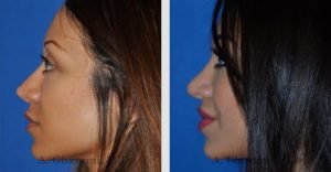 rhinoplasty_nose_bev_ZKhY6