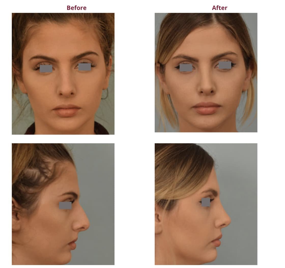 The Best Rhinoplasty Surgeons in Los Angeles My Beauty Consultant